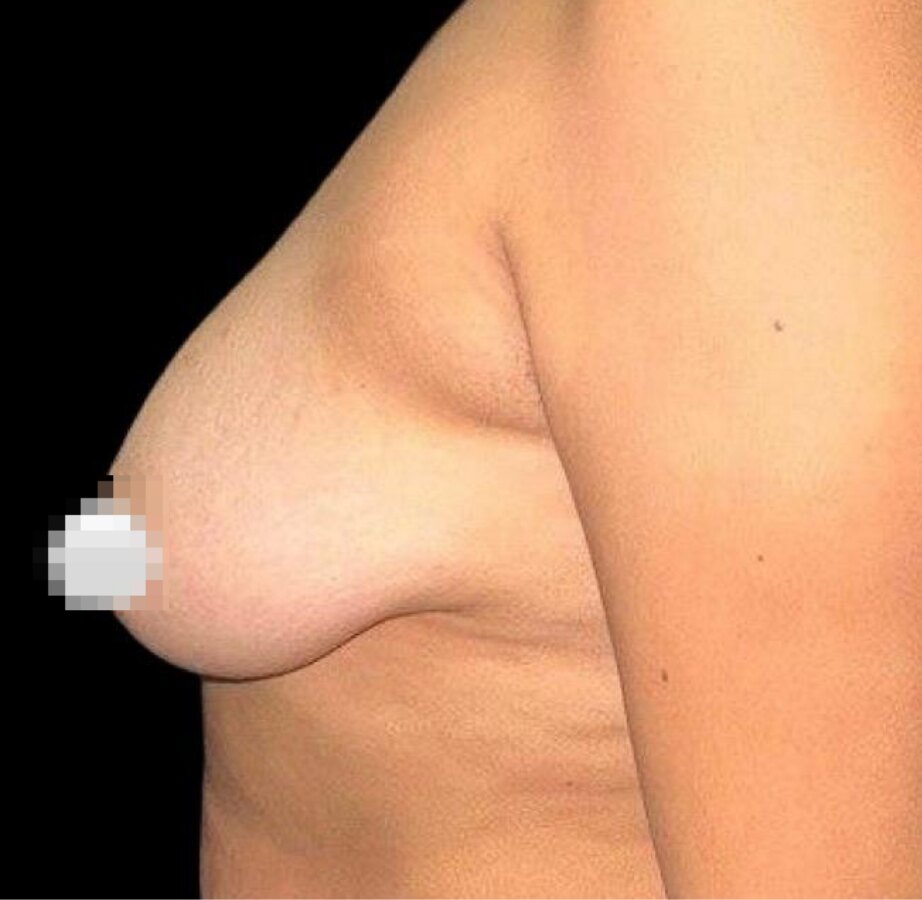 Antes